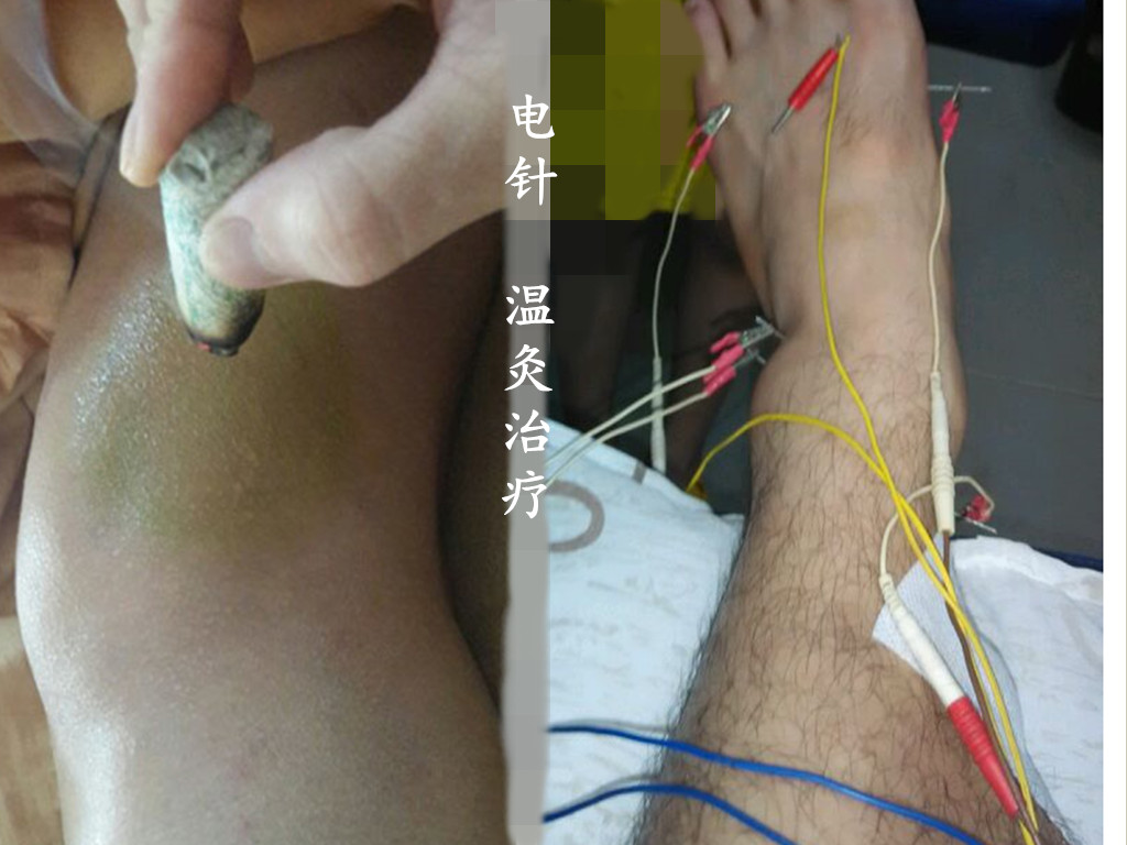 踝关节放血针刺什么部位,踝关节扭伤刺血疗法