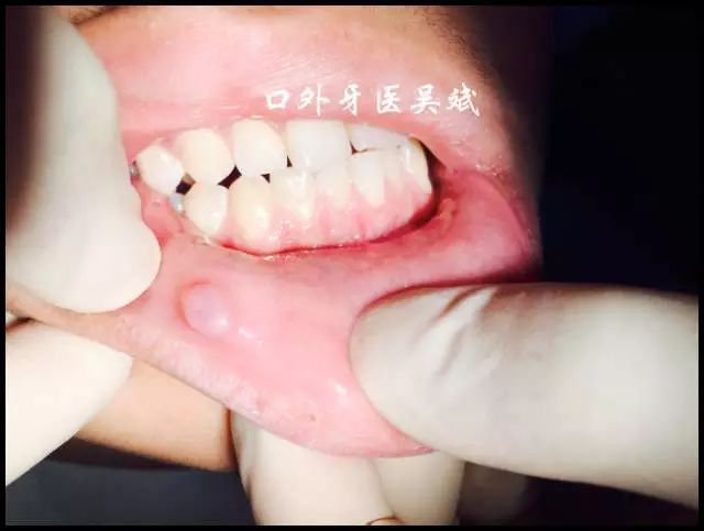 嘴里长疱怎么回事,嘴里起了好几个水泡怎么回事