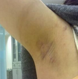 做完狐臭手术后还会长毛吗,做完狐臭手术还会臭吗