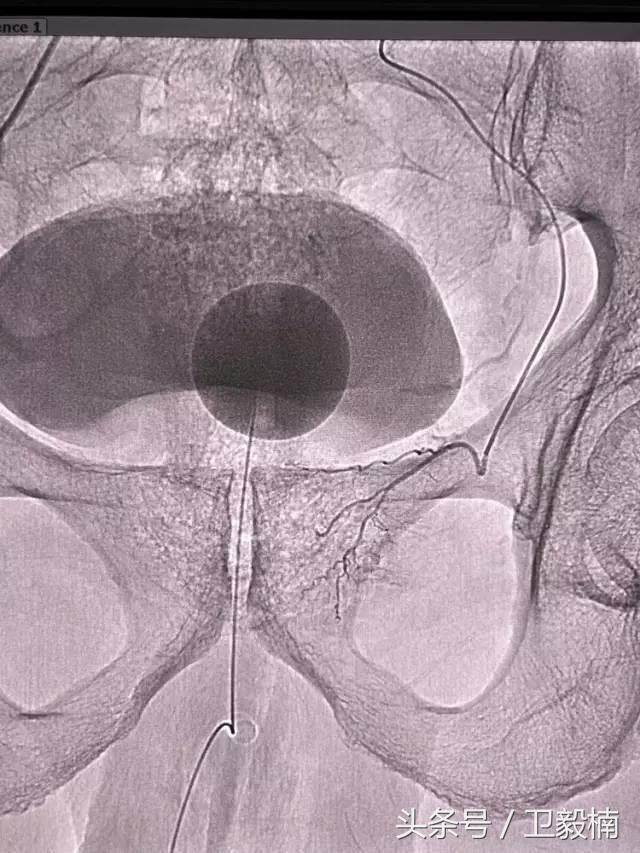 微创介入科一卫毅楠,什么是心血管介入治疗