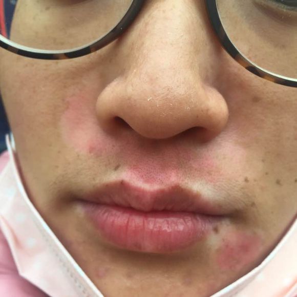 白斑光照,白斑光照后图片