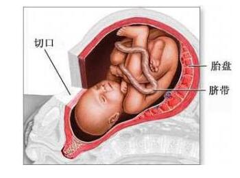 剖腹产伤口贴纸撕掉后怎么护理,剖腹产术后护理关注事项
