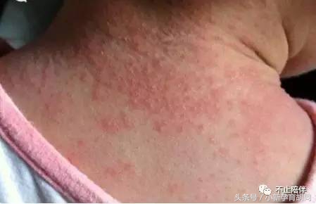 宝宝头上有湿疹,宝宝脸上的湿疹