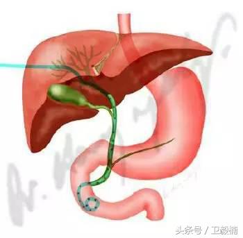 微创介入科一卫毅楠,什么是心血管介入治疗