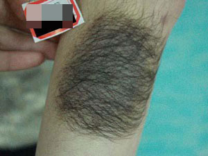 痣上长毛是什么征兆,痣上长毛能不能激光去除