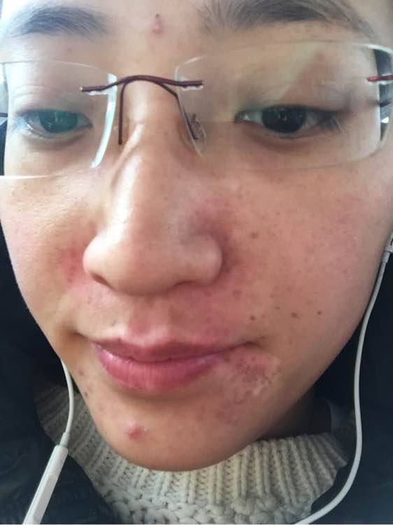 白斑光照,白斑光照后图片