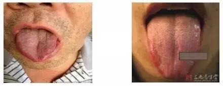 舌苔辨证图谱望舌识病,揭秘舌苔图谱轻松自诊