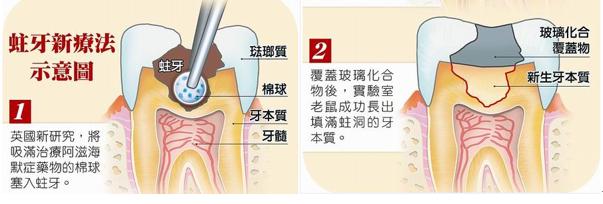 牙齿蛀牙治疗,有了蛀牙可以不去补牙吗