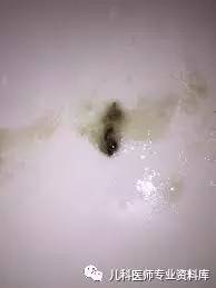 儿童鼻涕的秘密,儿童黄鼻涕粘稠