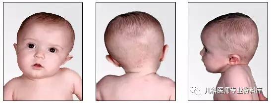 痉挛性斜颈患者说出了大秘密,痉挛性斜颈脖子歪照片