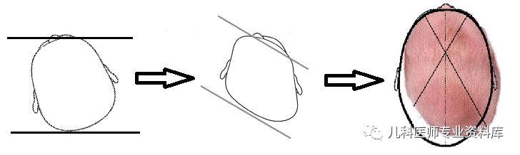 痉挛性斜颈患者说出了大秘密,痉挛性斜颈脖子歪照片