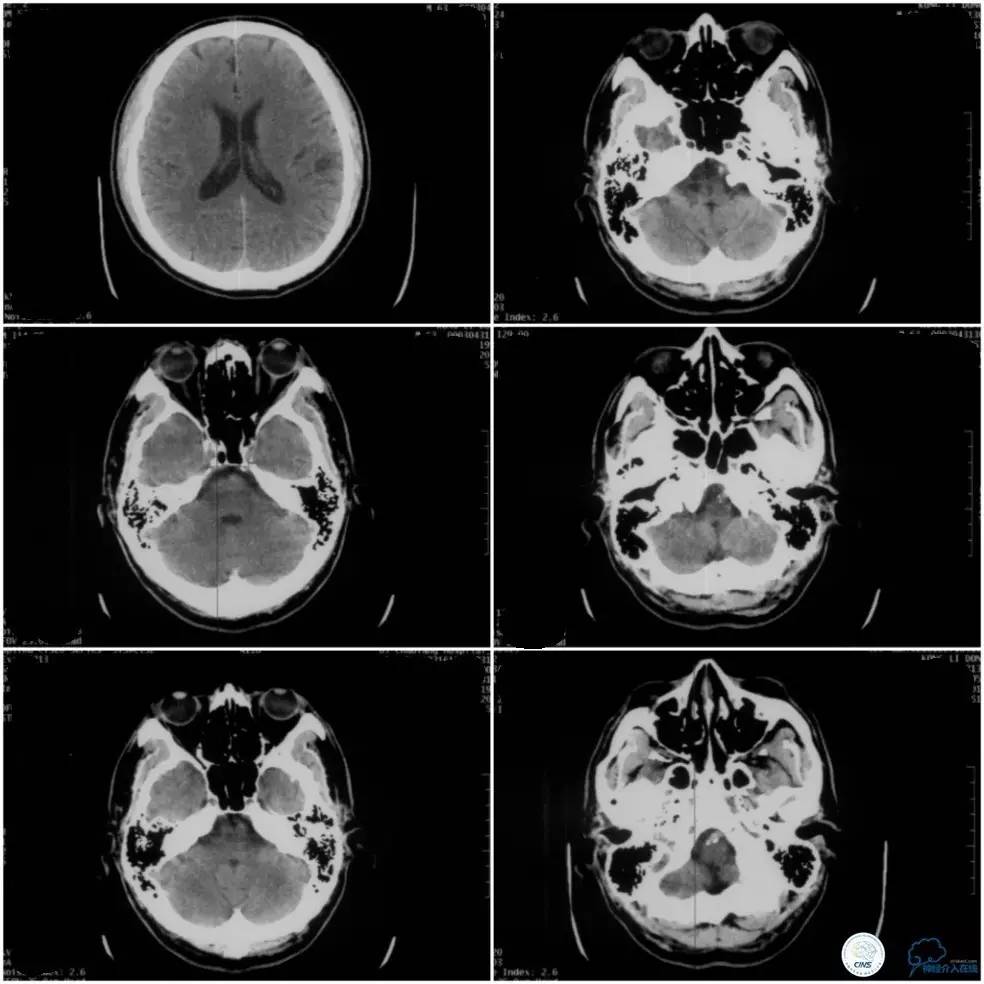 天坛周记｜基底动脉狭窄合并动脉瘤血管内介入治疗一例