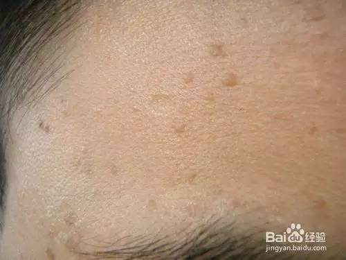 手上扁平疣,祛除扁平疣