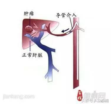 微创介入科一卫毅楠,什么是心血管介入治疗