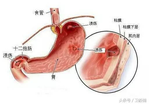 微创介入科一卫毅楠,什么是心血管介入治疗