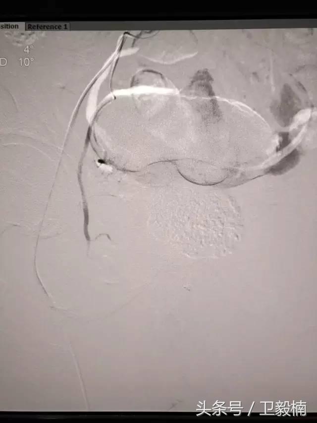 微创介入科一卫毅楠,什么是心血管介入治疗