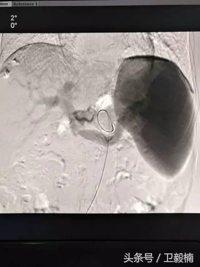 微创介入科一卫毅楠,什么是心血管介入治疗