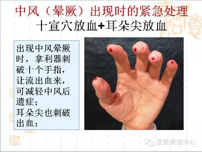 预防中风血栓的方法,怎么预防心脑血栓和脑梗