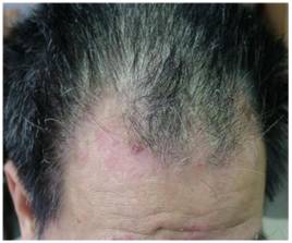 面部脂溢性皮炎怎么治疗断根,面部脂溢性皮炎各个阶段图片