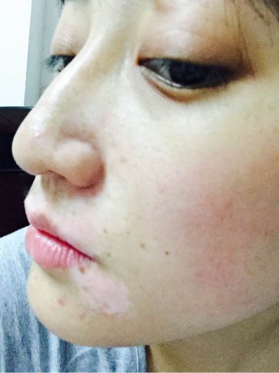 白斑光照,白斑光照后图片