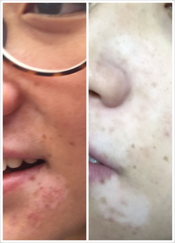 白斑光照,白斑光照后图片