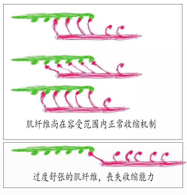 关于妇科手术病人拔尿管前定时夹闭尿管训练逼尿肌功能的逻辑反驳