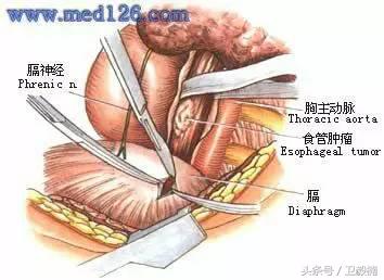 微创介入科一卫毅楠,什么是心血管介入治疗