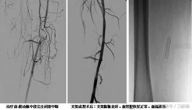 微创介入科一卫毅楠,什么是心血管介入治疗