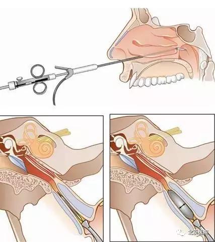 原来坐飞机难受是因为TA，听听北京医院专家怎么说？