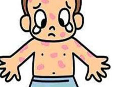 小孩长水痘身上痒用什么药,身上长水痘可以吃鸡蛋吗