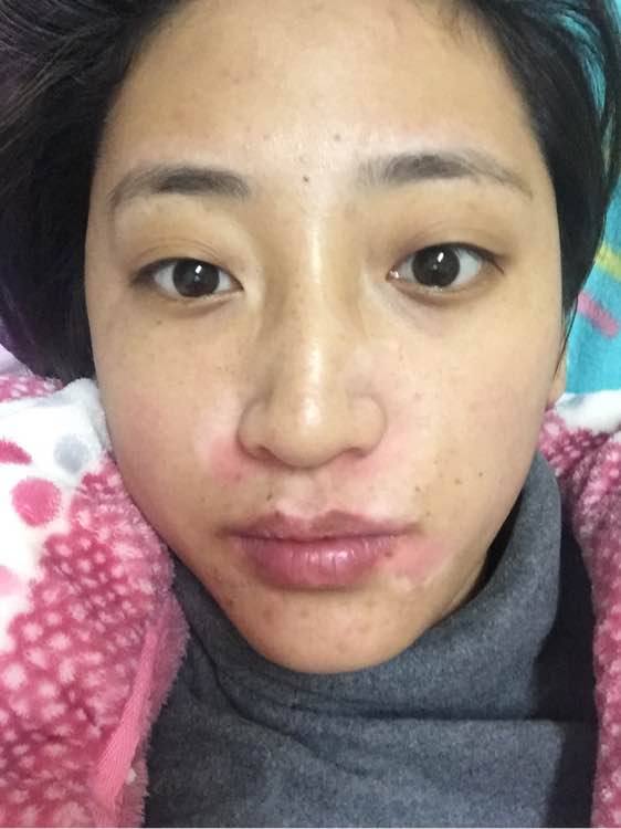 白斑光照,白斑光照后图片