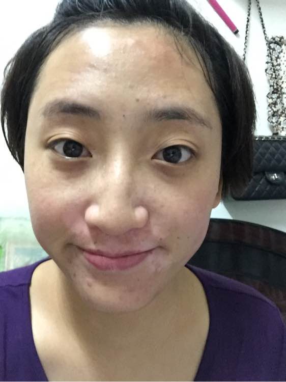 白斑光照,白斑光照后图片