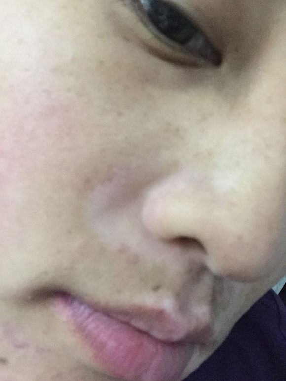 白斑光照,白斑光照后图片