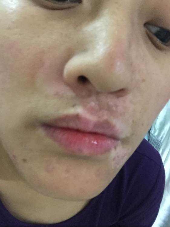 白斑光照,白斑光照后图片