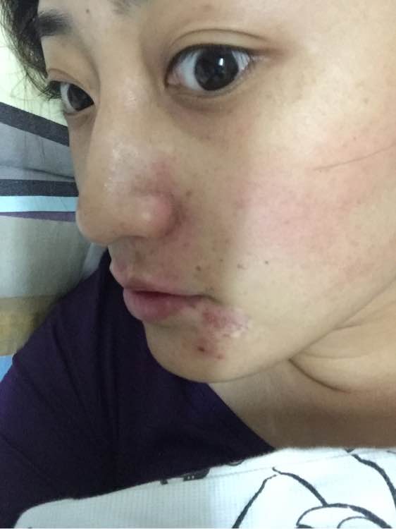 白斑光照,白斑光照后图片