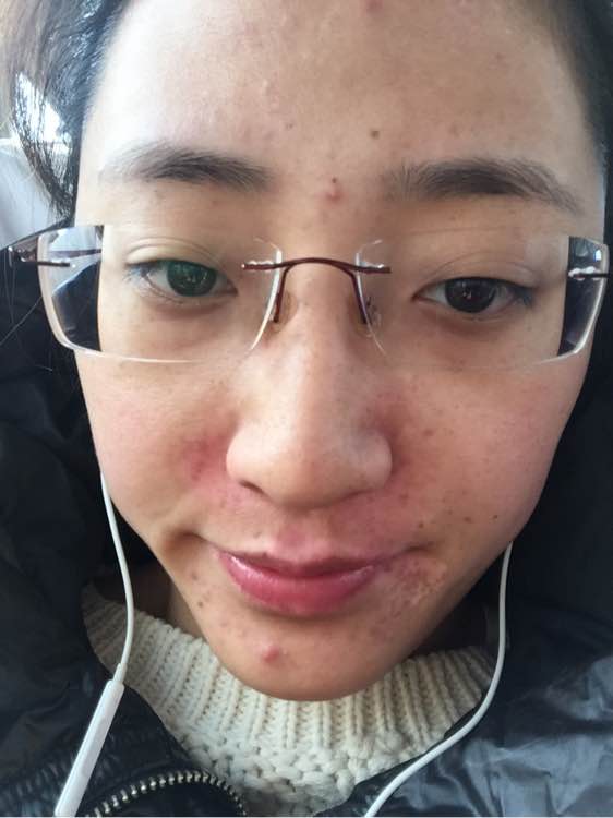 白斑光照,白斑光照后图片