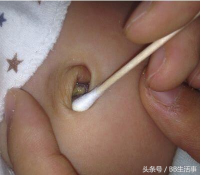 宝宝出生后“肚脐”未长好,护理不当很容易发炎!