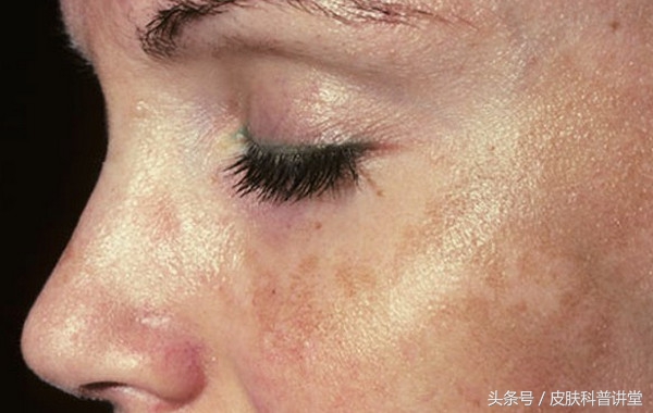 褐青色斑平时要关注什么,长褐斑是什么原因