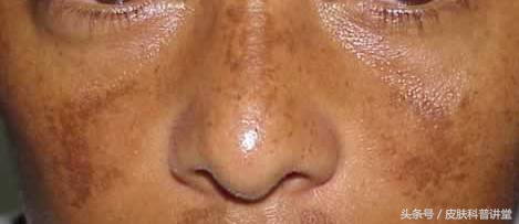 褐青色斑平时要关注什么,长褐斑是什么原因
