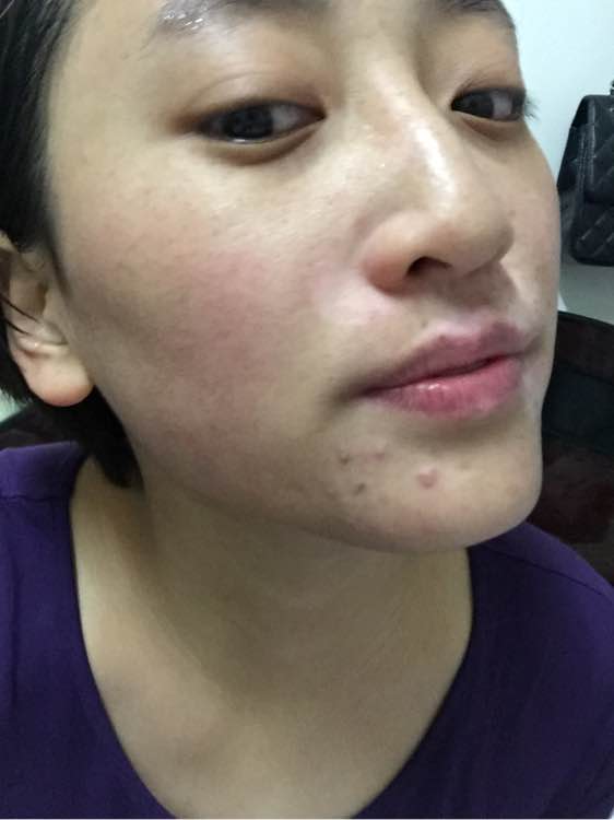 白斑光照,白斑光照后图片