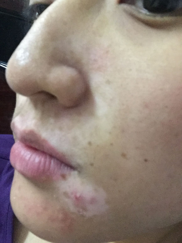 白斑光照,白斑光照后图片