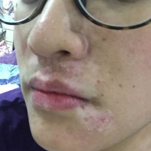 白斑光照,白斑光照后图片