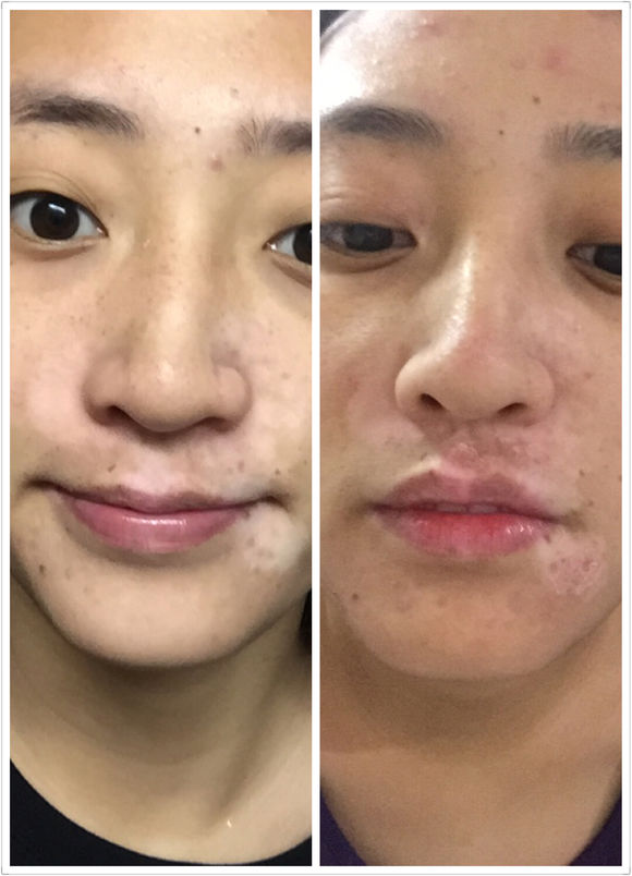 白斑光照,白斑光照后图片