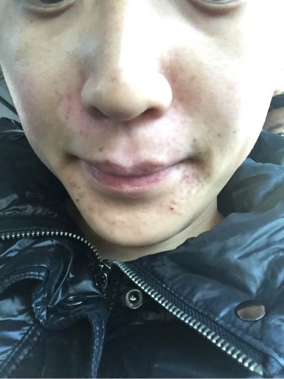 白斑光照,白斑光照后图片