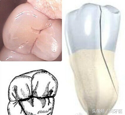 过年牙齿掉了一块,过年牙齿掉好不好