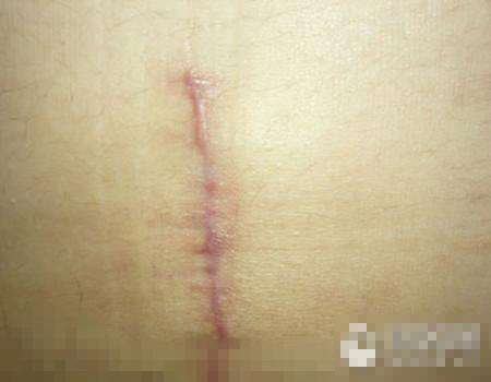 女人剖腹产之后腰疼,女人剖腹产之后的文案