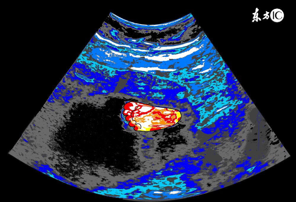 孕妈须知：B超不是万能，孕期这些胎儿异常是检查不出来的！
