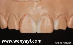 门牙有缝的女人有什么不好,门牙有缝怎么办