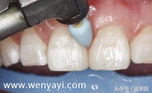 门牙有缝的女人有什么不好,门牙有缝怎么办