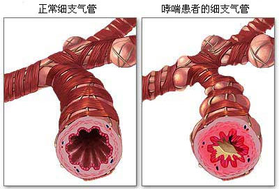 怎么应对哮喘,哮喘急性发作怎么处理